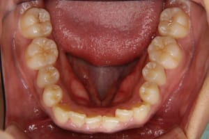 矯正歯科治療前の下顎です。前歯部がでこぼこしています。